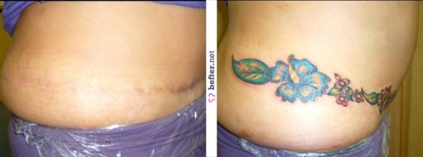 before-after-belly-tattoo-covering-up-scars-by-panchovilla-b2