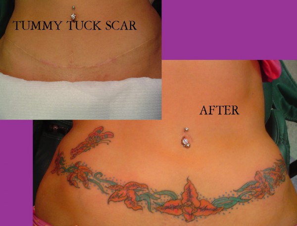 cover-up-tummy-tuck-scar-vvmujh