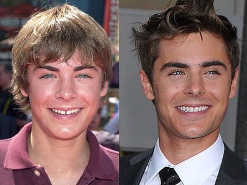 9-les-pires-dentitions-de-stars-zac-efron