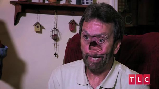 Cet homme a vécu avec un trou au milieu du visage