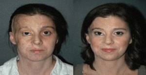reconstruction faciale