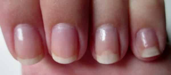 Vous Avez Des Tâches Blanches Sur Les Ongles ? C'est Incroyablece N 