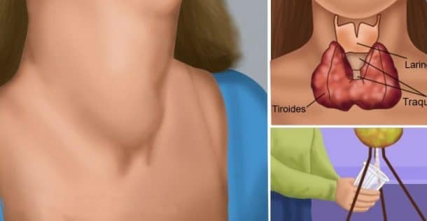 troubles de la thyroide