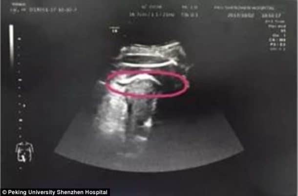 Son Bebe Lui A Dechire L Uterus En Donnant Un Coup De Pied Dans Son Ventre