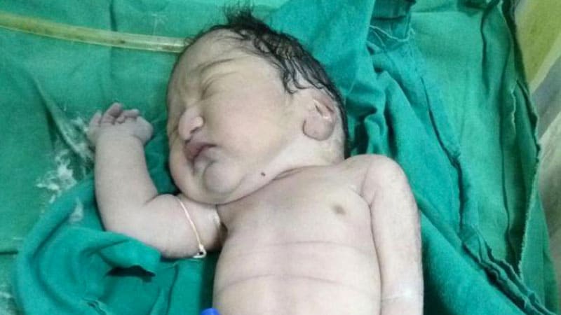 Incroyable Un Bebe Est Ne Avec Une Queue De Sirene En Inde