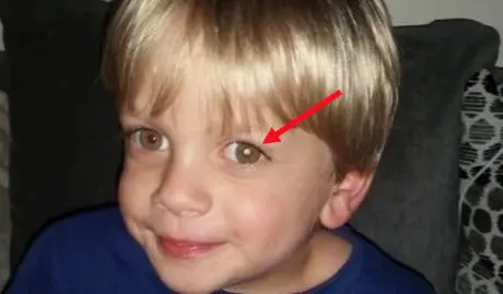 enfant cancer oeil fleche