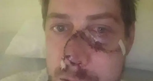 Un cerf percute un chasseur et lui arrache la moitié du visage