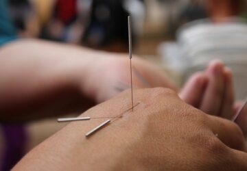 acupuncture