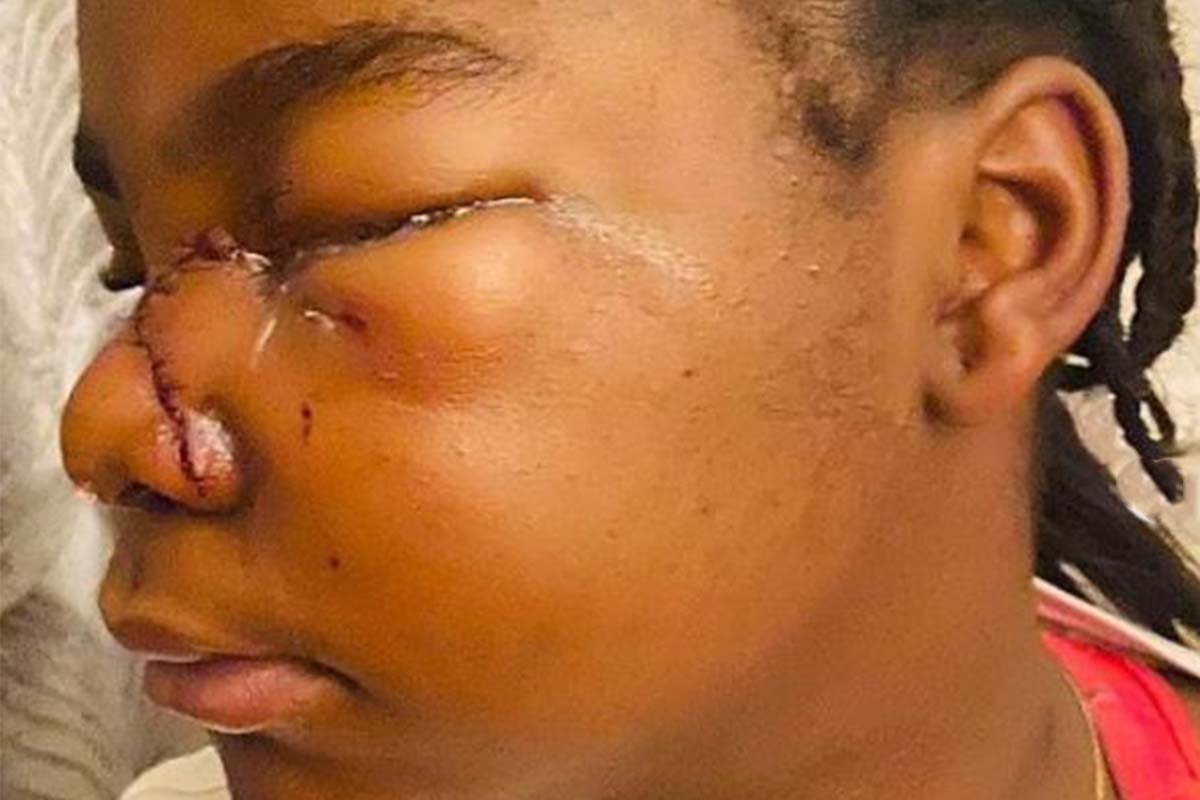 chambery fille violences racistes defiguree