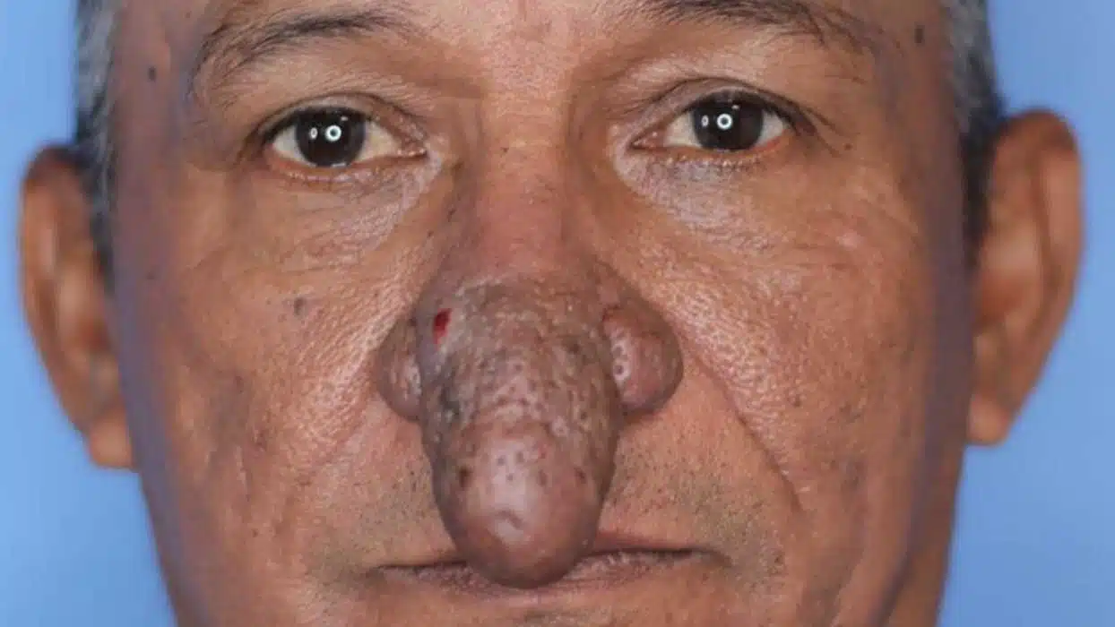 cet homme au nez difforme opéré