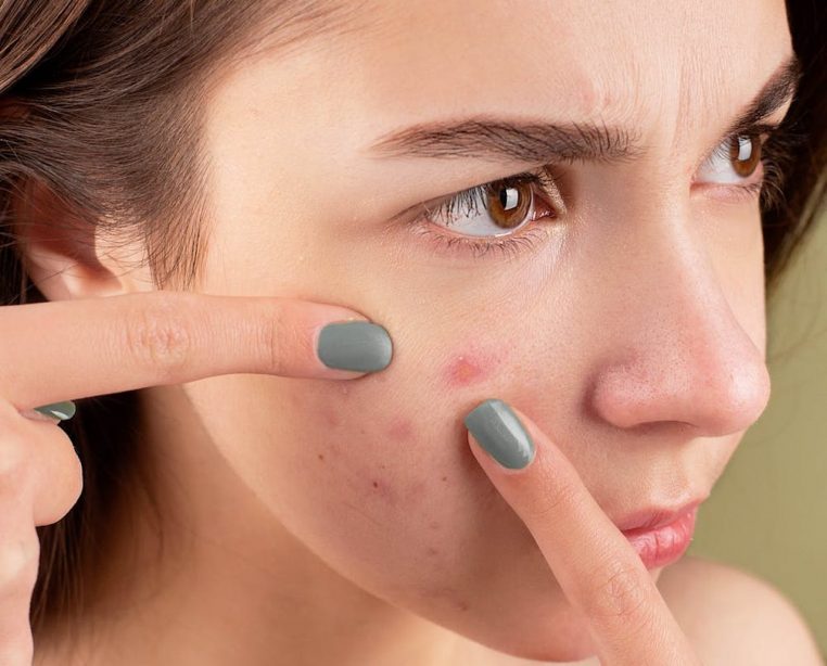 Pimple popping » : Percer son bouton, si, si, on peut le faire