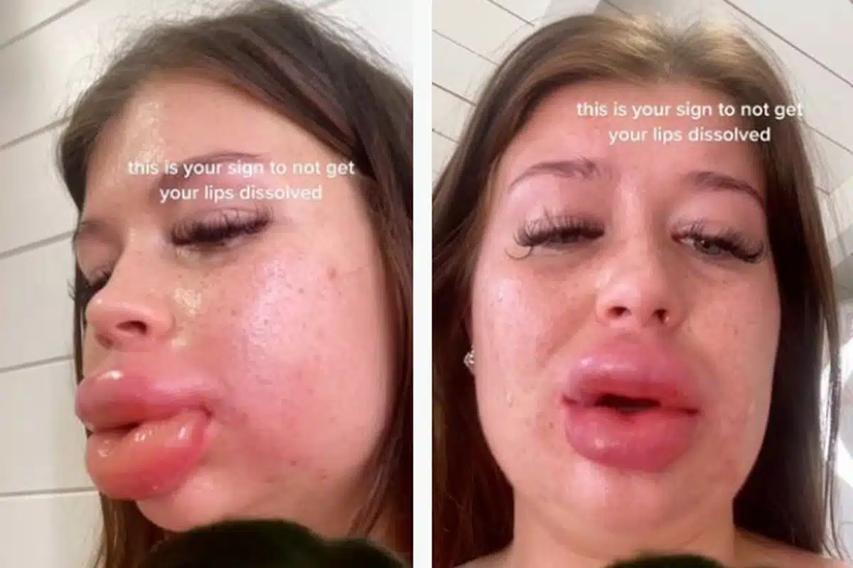 tiktok levres operation chirurgie esthetique