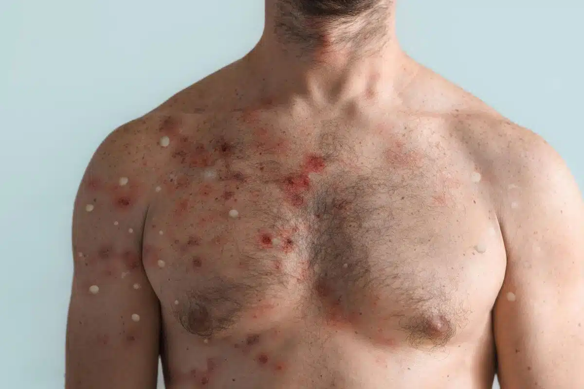 variole du singe nouveau symptome yeux