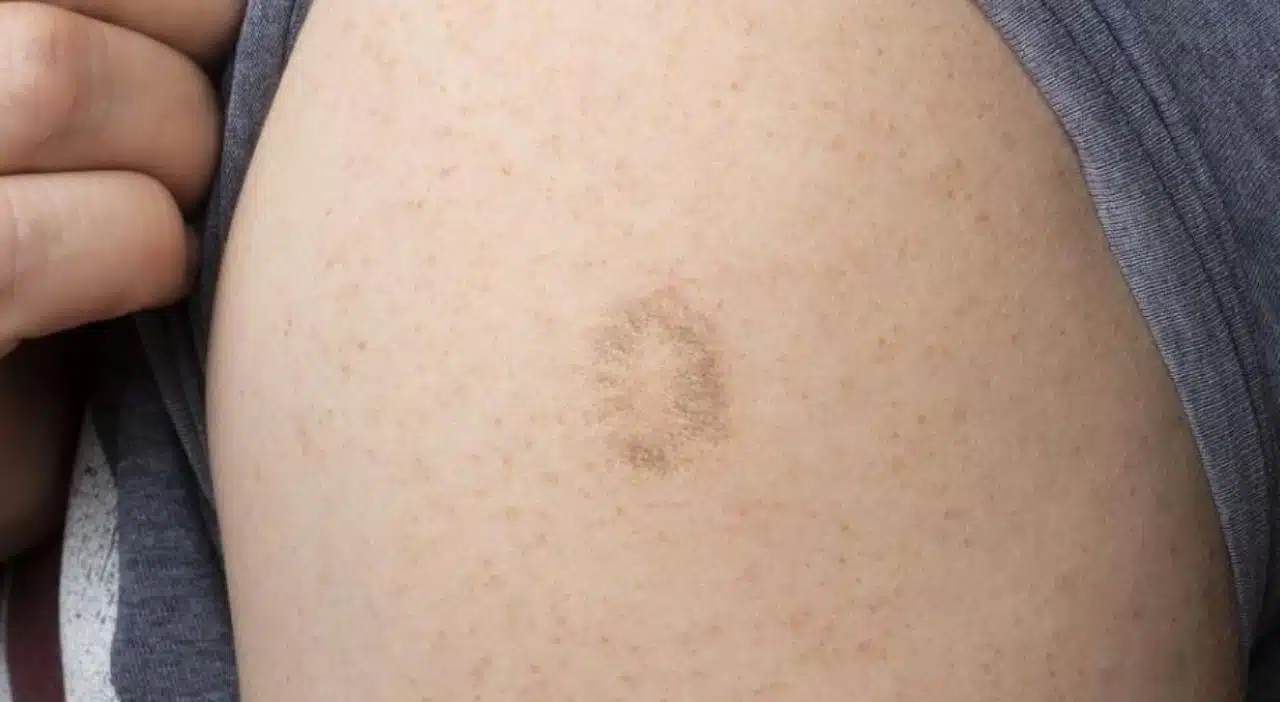 vaccin variole