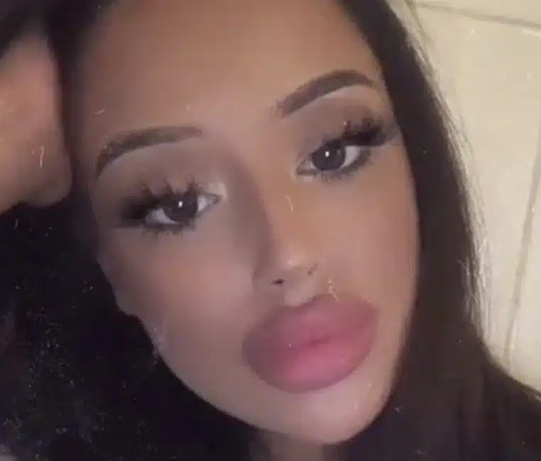 chirurgie esthétique tiktok lèvres injections