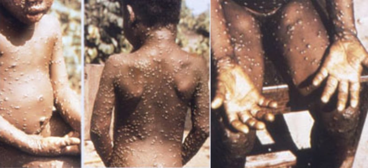 MonkeyPox-CDC3-urgence-sanitaire-oms